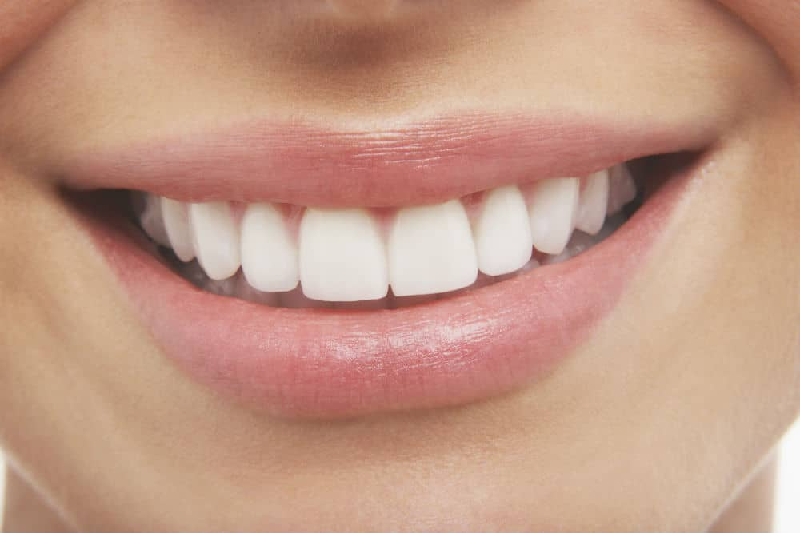 Why Dental Veneers Are Called the Hollywood Makeover