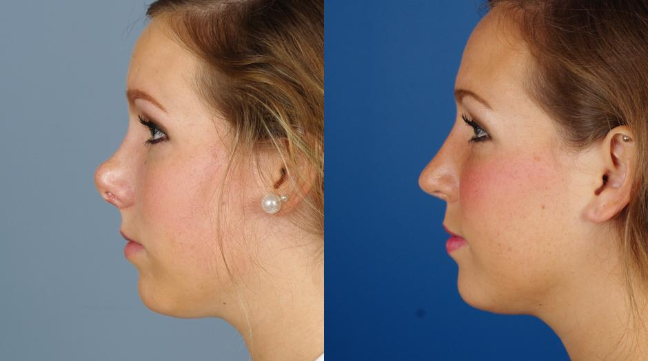 HOW TO KNOW THAT YOU MIGHT NEED A REVISION RHINOPLASTY?