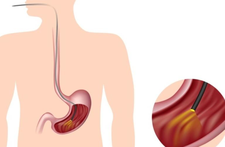 GI Endoscopy: Why is It Done?