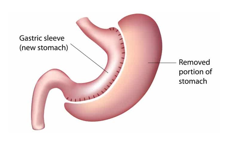 Getting Set for Gastric Sleeve