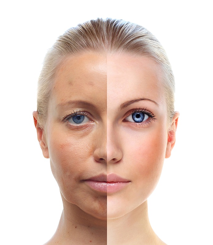 WHAT IS RECOVERY LIKE AFTER THE FACELIFT SURGERY?