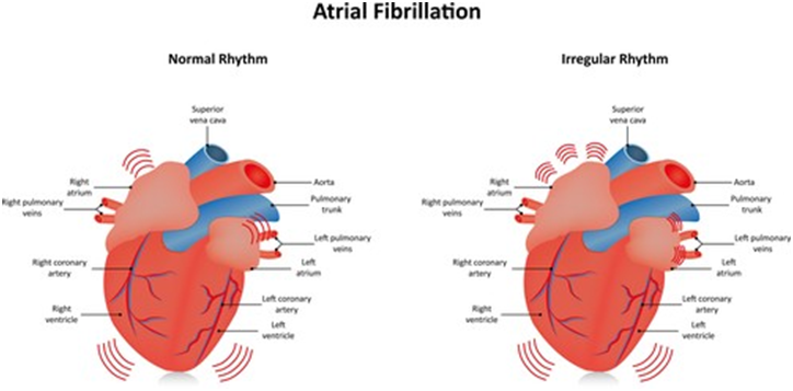 Atrial fibrillation – Symptoms and treatment