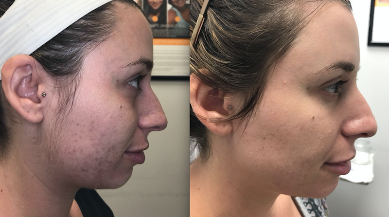 Microneedling with PRP: Stop aging with facial rejuvenation
