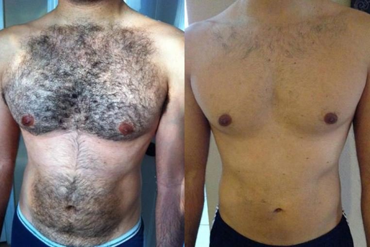 Best and cheapest laser hair removal for men