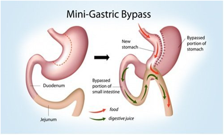 What to choose between mini bypass and gastric bypass?