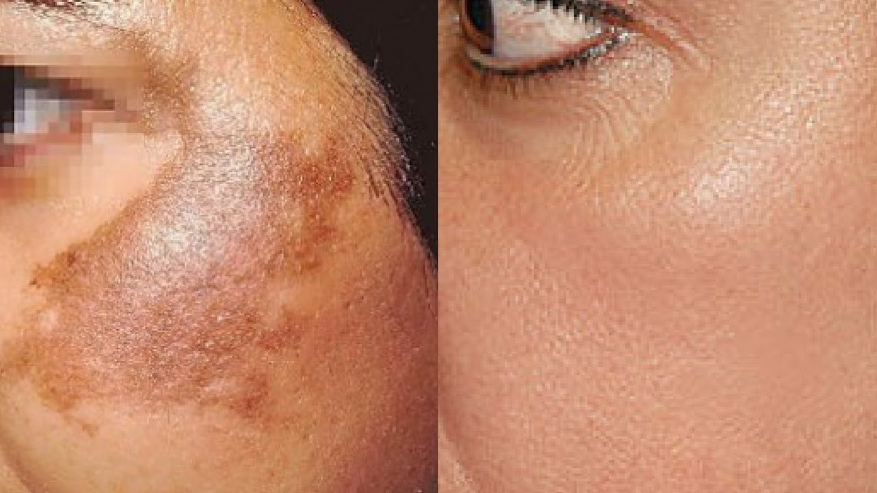 What is Hyperpigmentation and What are the Treatments to Address This?