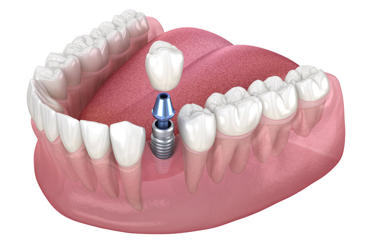 What Does a Dental Implant Procedure Look Like?