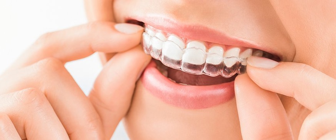 Transform Your Smile With Dentist Invisalign Aligners