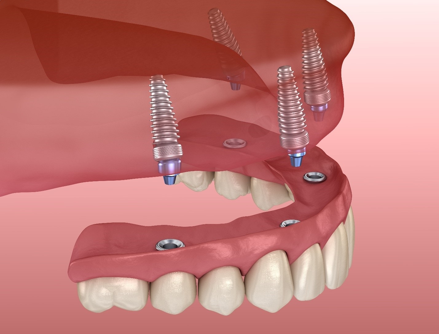 Seven common questions and answers about dental implants