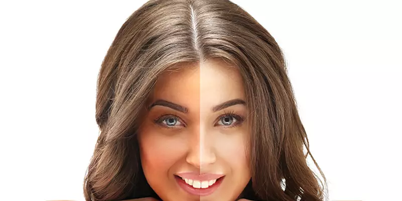 Skin Lightening treatments – Causes, Effects, Treatments, and Results