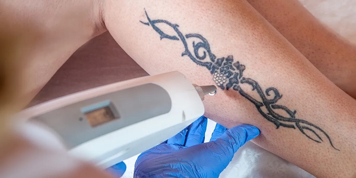 Non-Surgical Tatto Removal: How It Works