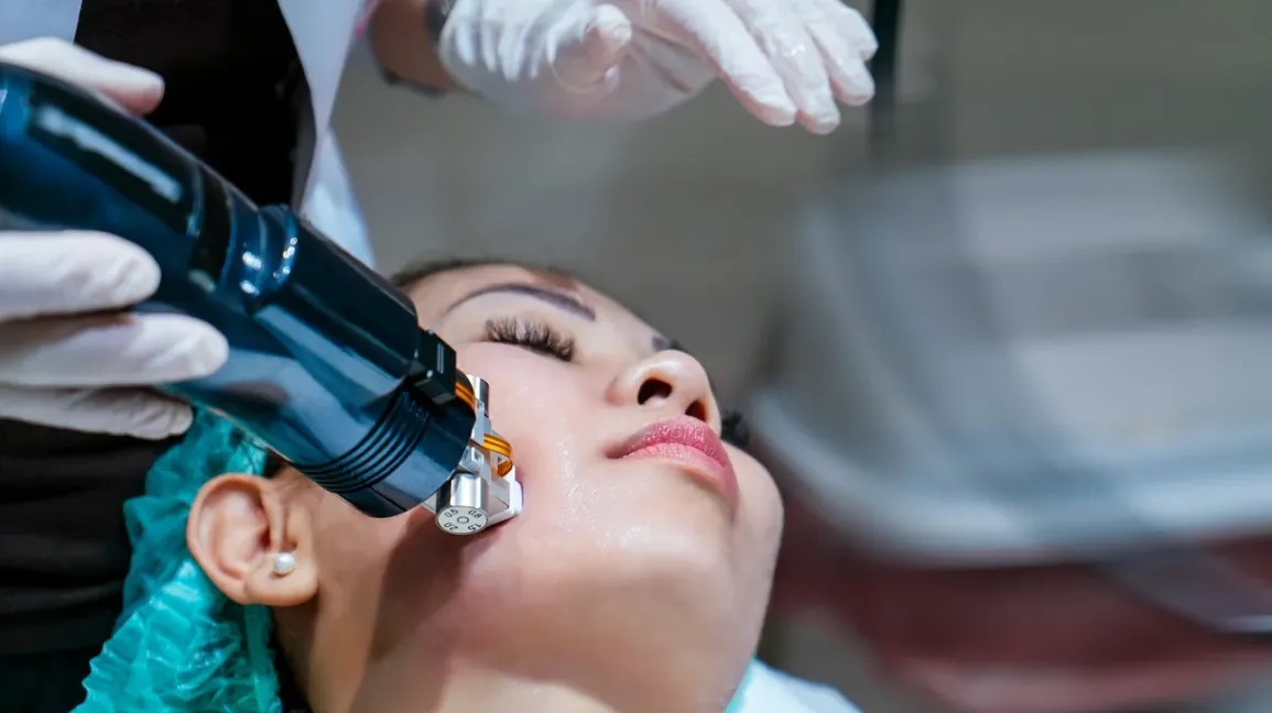 Everything You Should Know Before Having Rf Microneedling For Acne Treatment