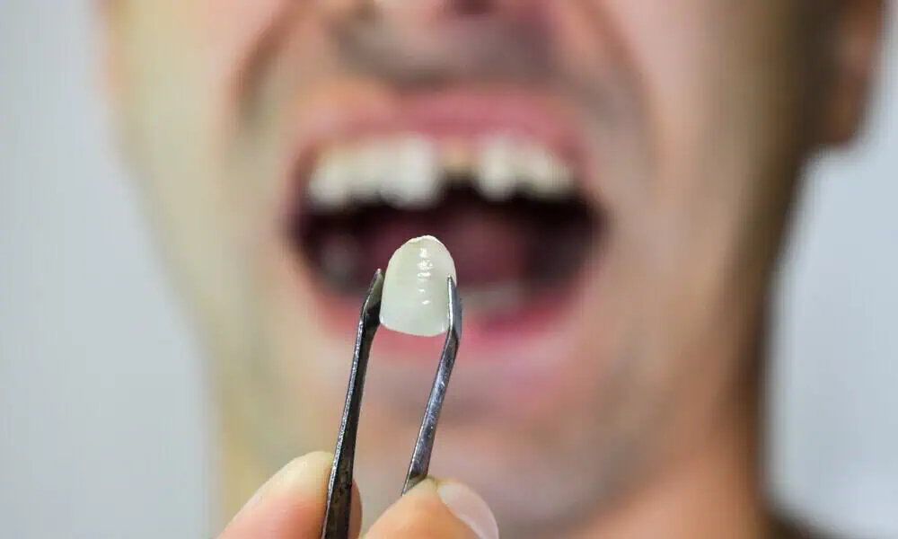 Porcelain Veneers