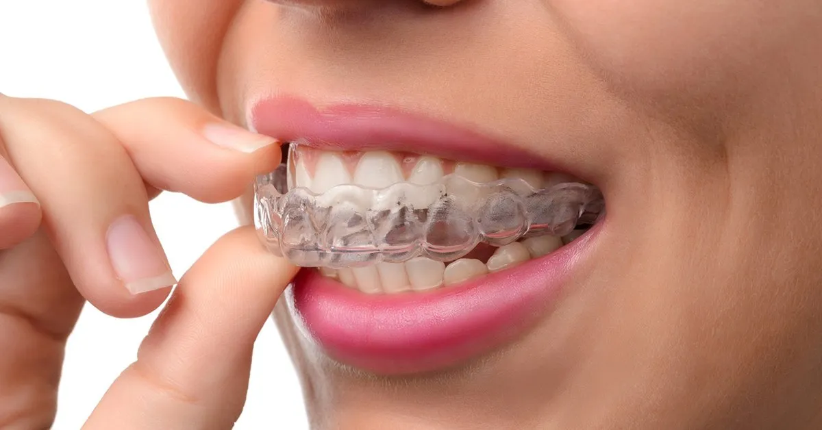INVISALIGN-HOW THE PROCEDURE WORKS