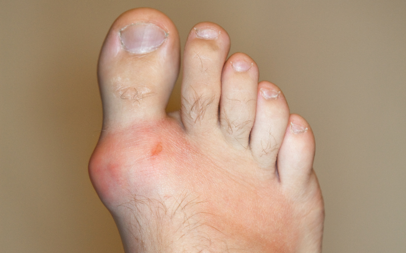 Bunion Pain or Something Else? How to Identify the Signs