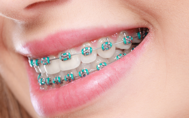 Are Cheap Braces in Singapore Safe for Long-Term Use?